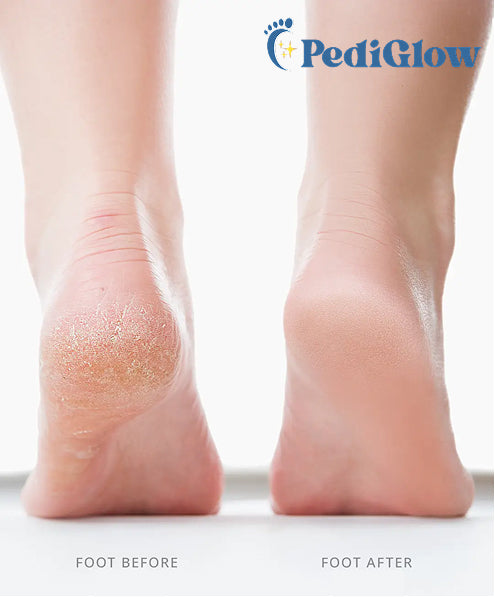 PediGlow Flawless Electronic File Tool and Callus Remover ✨